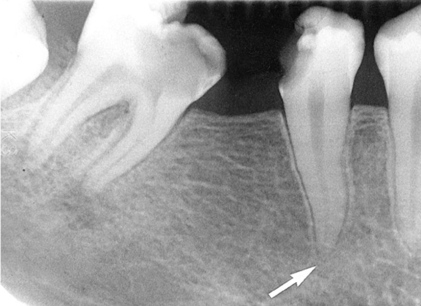 <p>inflammation and destruction of apical periodontium of pulpal origin</p><ul><li><p>no periapical changes are noted yet</p></li><li><p>sometimes cannot be diagnosed by radiographic images alone</p></li><li><p>variable presentation → asymptomatic, mild toothache, severe pain and swelling</p></li></ul><p></p>