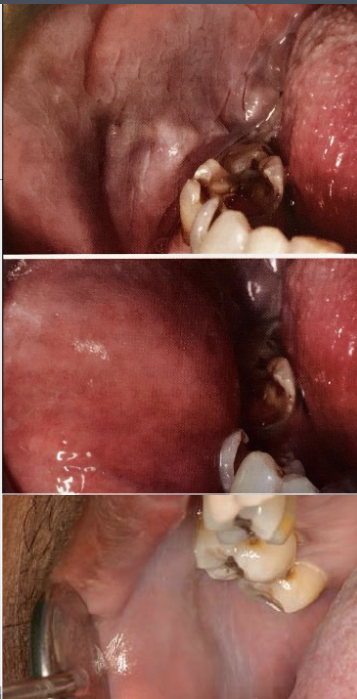 <p>Diffuse, gray-white, milky, opalescent lesions found bilaterally on buccal mucosa</p>