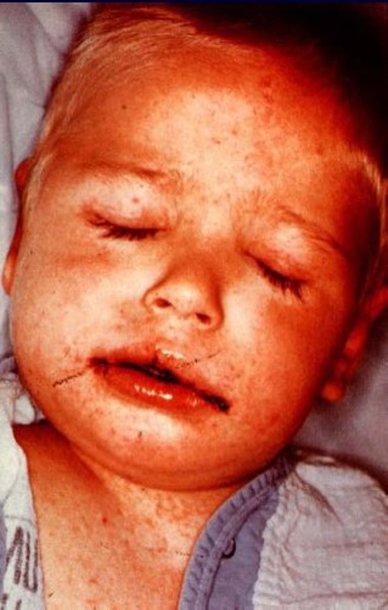 <p>What labs should be ordered if a patient presents with a combination of rash and facial edema?</p>