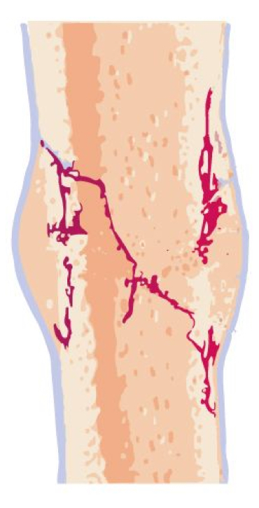 <p>the bony callus is then remodeled by osteoclasts and osteoblasts, with excess material on the exterior of the bone and within the medullary cavity being removed</p><p>compact bone is added to create bone tissue that is similar to the original, unbroken bone</p><p>this remodeling can take many months</p><p>the bone may remain uneven for years</p><p>8 weeks-2 years</p>