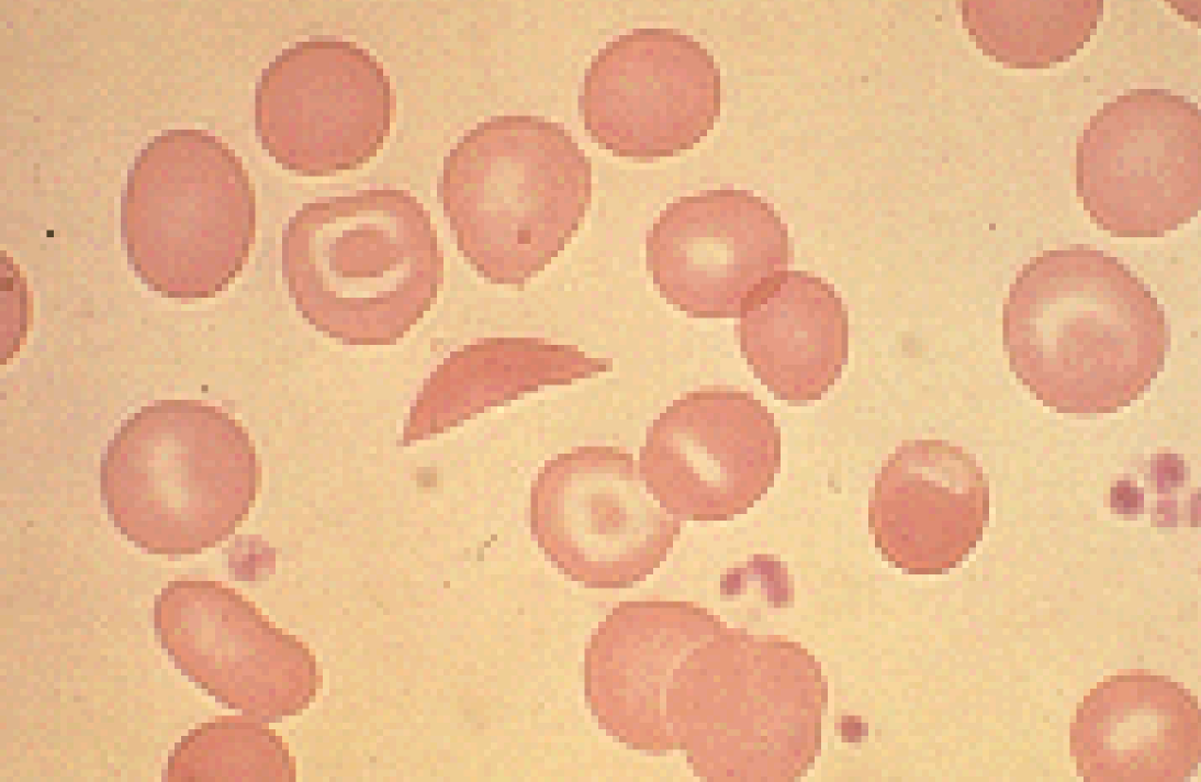 Nx in deer

(Sickle Cell)