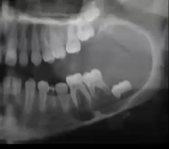 <p>expansile lesion that appears to envelop developing tooth </p>