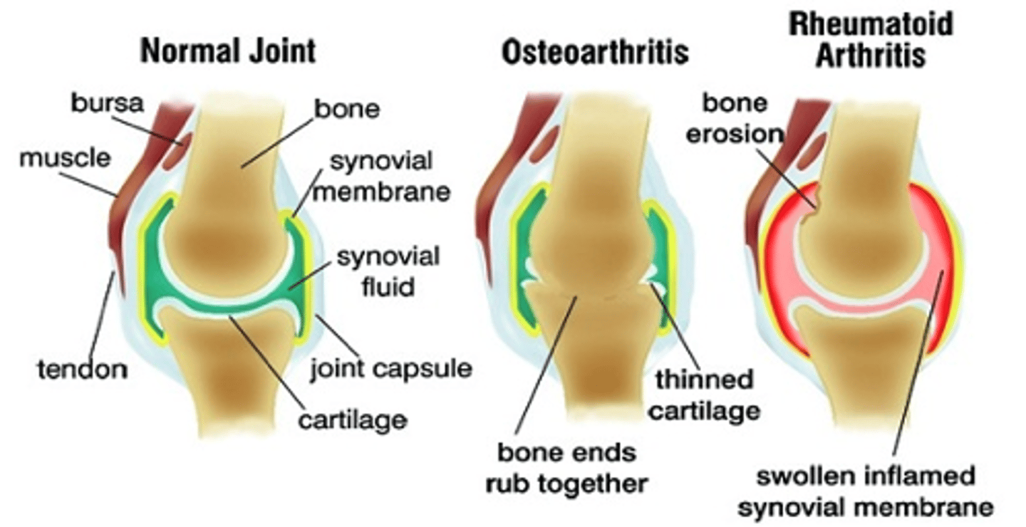 <p>Osteoarthritis</p><p>-bone on bone (bone rubs together)</p><p>-thinned cartilage</p><p>-fusiform swelling of joints</p><p>-heberden's nodes</p><p>Rheumatoid arthritis</p><p>-bone erosion</p><p>-swollen inflamed synovial fluid</p><p>-ulnar drift of MCPs, boutonniere deformity of thumb, swan neck deformity of fingers</p>