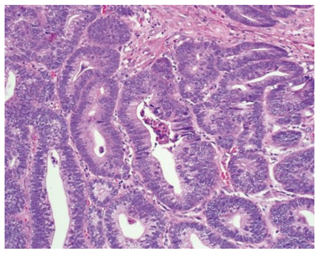 <p>&nbsp;<mark data-color="red" style="background-color: red; color: inherit">A 58-year-old man was admitted with upper abdominal dull pain that had persisted for one month. The patient had no relevant past medical history. The results of the physical examinations were unremarkable. Laboratory investigation showed that the patient’s serum carcinoembryonic antigen was elevated to 1945 mcg/L (normal: 0-2.5 mcg/L). An upper endoscopic examination revealed a large fungating mass with a central ulceration at the lesser curvature extending from the angle to the antrum of the stomach. CT scan of the abdomen and pelvis revealed thickening of the wall of the antrum, enlarged lymph nodes at the lesser curvature, and multiple hepatic metastases. A gastric biopsy was performed, and the microscopic appearance of the biopsy specimen is shown in the attached figu</mark><span style="color: var(--ic-brand-font-color-dark)"><mark data-color="red" style="background-color: red; color: inherit">re. Molecular studies of tumor cells would most likely reveal abnormalities in which of the following genes encoding?</mark></span></p><p></p><p><mark data-color="red" style="background-color: red; color: inherit">Adenomatous polyposis coli</mark></p><p></p><p><mark data-color="red" style="background-color: red; color: inherit">β-catenin</mark></p><p><mark data-color="red" style="background-color: red; color: inherit">&nbsp;</mark></p><p><mark data-color="red" style="background-color: red; color: inherit">E-cadherin</mark></p><p><mark data-color="red" style="background-color: red; color: inherit">&nbsp;</mark></p><p><mark data-color="red" style="background-color: red; color: inherit">P16 protein</mark></p><p><mark data-color="red" style="background-color: red; color: inherit">&nbsp;</mark></p><p><mark data-color="red" style="background-color: red; color: inherit">P53 protein</mark></p>
