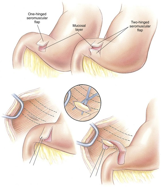 <p>Seromuscular flap that is pulled &amp; fixed behind 11th/12th rib</p>