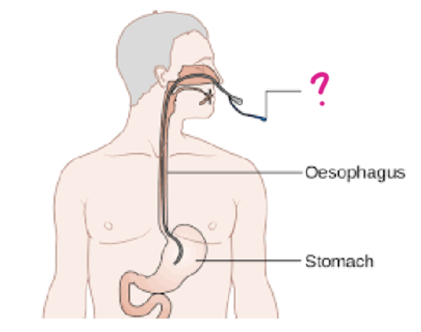 <p>a form of enteral administration in which: </p><ul><li><p>a flexible, plastic tube is inserted through the nose down into the stomach </p></li><li><p>used to administer nutrition and medications</p></li></ul><p></p>