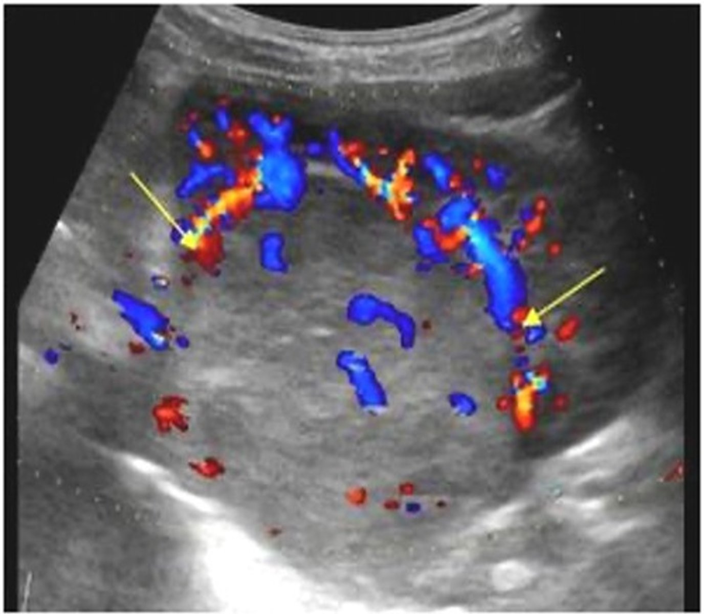 <p>Nephroblastoma may be found with ___ obstruction with findings of leg edema, varicocele, or Budd-Chiari syndrome </p>