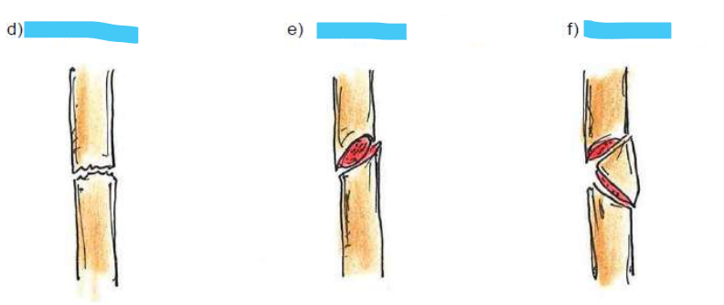 <p>Knochenbruchformen</p>