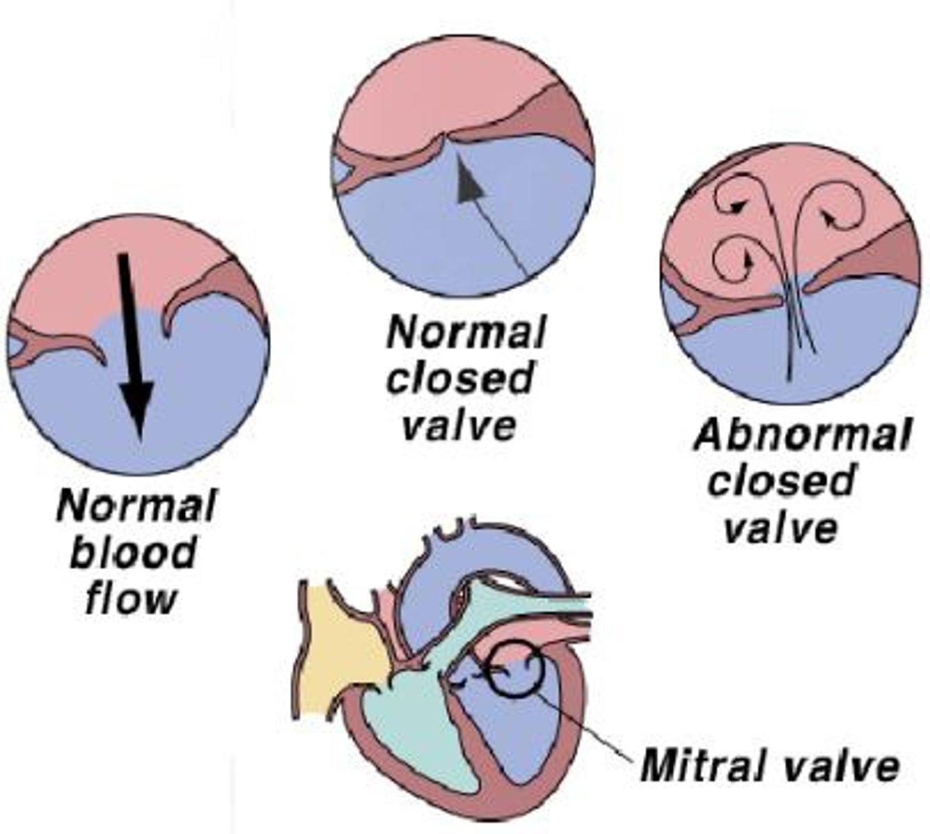 <p>abnormal heart sounds made by incompetent (leaky) or stenotic (stiff) valves</p>