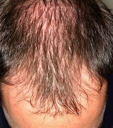 <p>the hair loss starts at the temples, then an enlarging bald spot @ the top of the head</p>