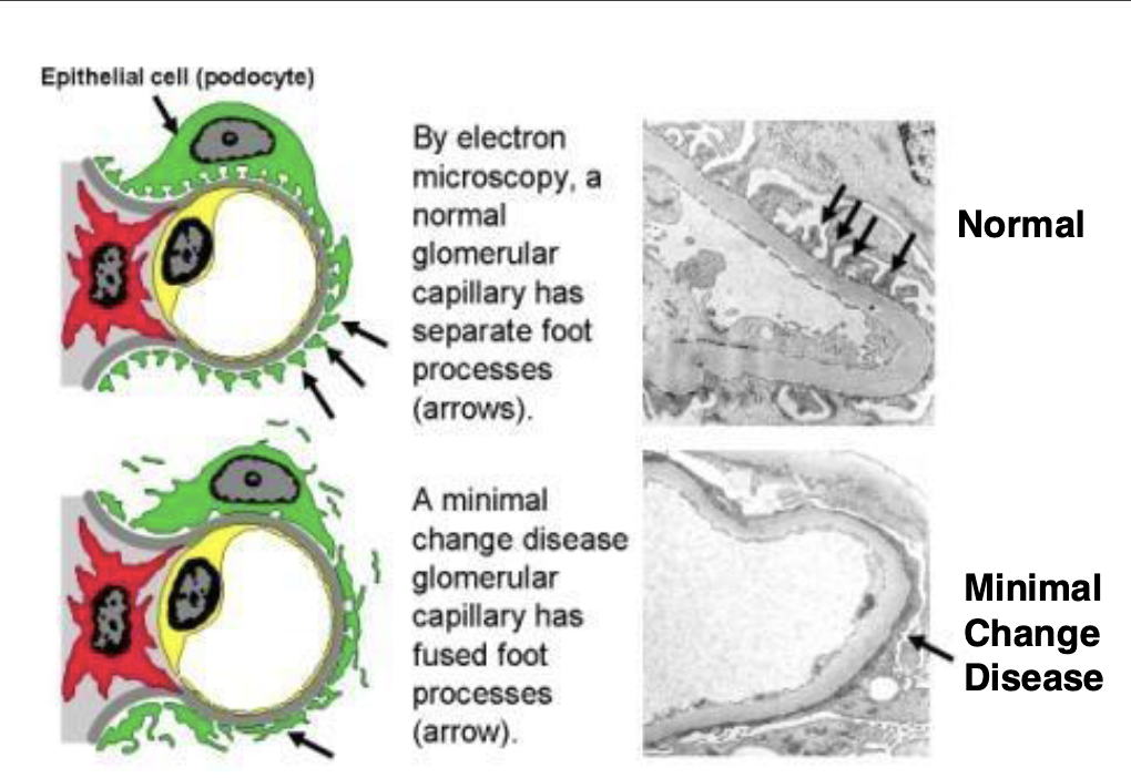 <ul><li><p>Also known as <strong>Nil Disease</strong> since no abnormalities found by light microscopy, requires electron microscopy to see pathology</p></li><li><p>Occurs mainly in children (2-6 years old) and is most common</p><p>kidney disease of childhood, generalized edema (anasarca) is the most prominent clinical sign</p></li><li><p>Relatively benign disease that doesn’t progress to renal failure</p></li><li><p>Unknown cause, <em>there are NO immune complexes or complement activation</em></p></li><li><p>By light microscopy glomeruli appear normal, <em>but electron</em></p><p><em>microscopy shows fusion of the podocyte foot processes</em></p></li><li><p>Corticosteroid therapy is effective, long-term prognosis is good</p></li></ul><p></p>