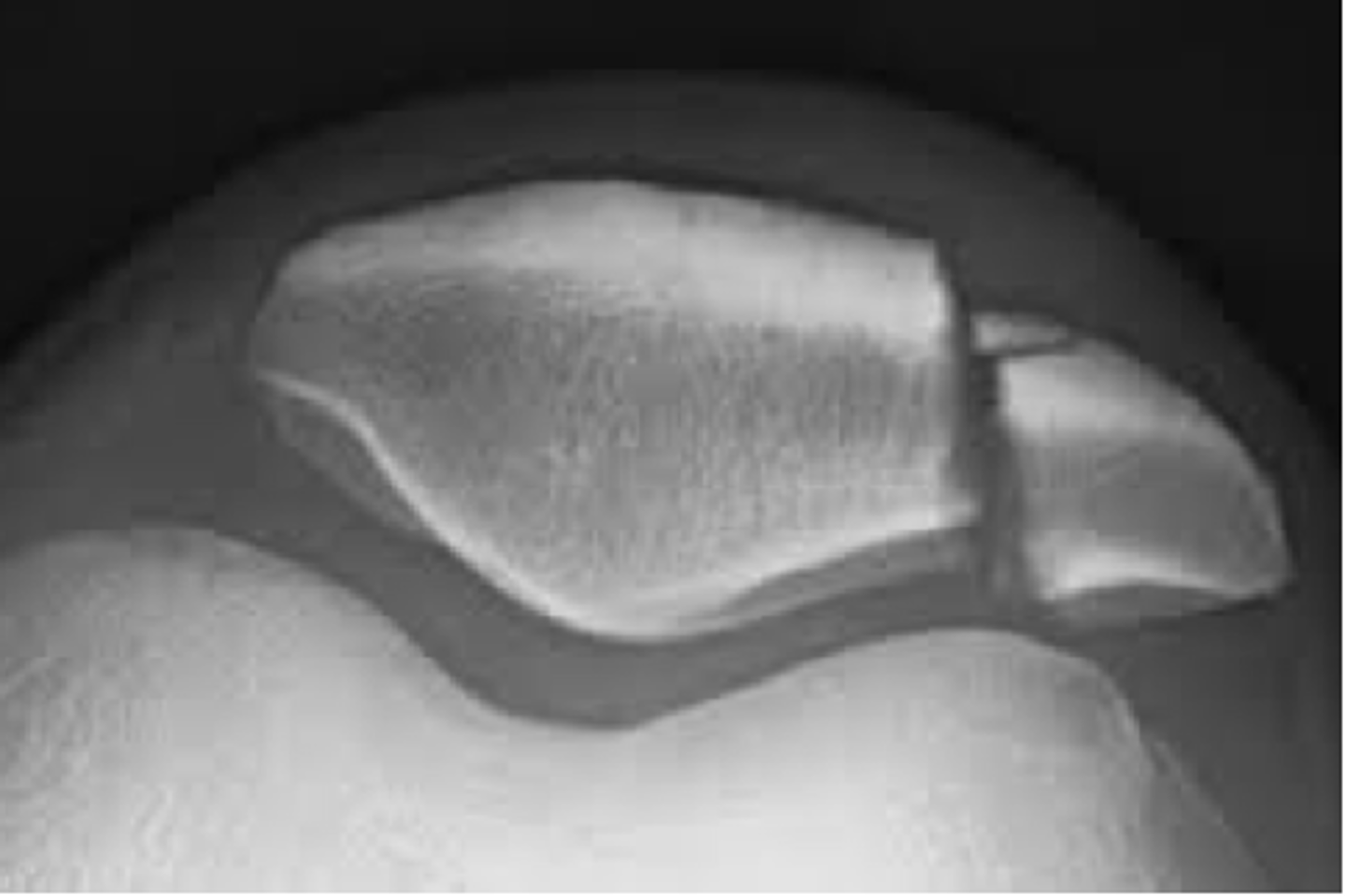 <p>Patella fracture</p>