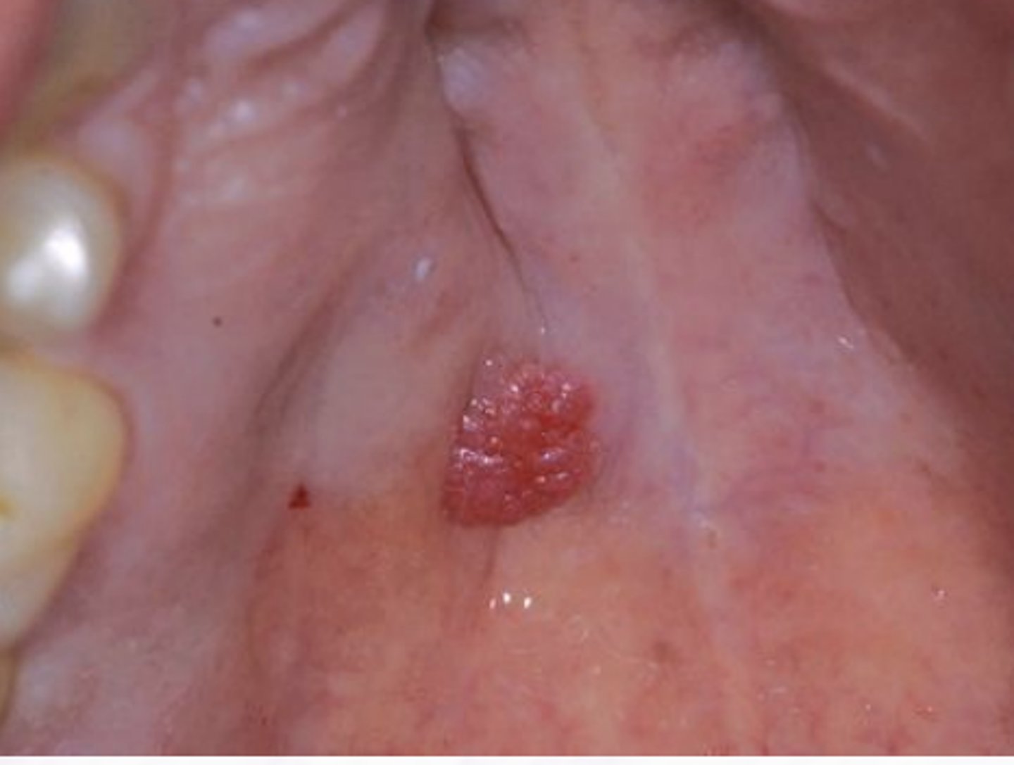 <p>Ductal Papilloma</p>