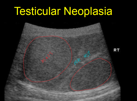 <ul><li><p><strong><u>Orchitis</u></strong></p><ul><li><p><strong>infection</strong> of testicle parenchyma</p></li></ul></li><li><p><strong>Hydrocoele</strong></p><ul><li><p>anechoic<strong> fluid</strong> around testicle</p></li></ul></li><li><p><strong><u>Seminoma and interstitial cell tumors</u></strong></p><ul><li><p>appear as<strong> mixed echogenic masses</strong> within testicle</p></li></ul></li><li><p><strong><u>Sertoli cell tumor</u></strong></p><ul><li><p><strong>hypoechoic nodules</strong></p></li><li><p>common in <u>retained testicles</u></p></li></ul></li><li><p><strong>Epididymitis</strong></p><ul><li><p>increased echogenicity of the epididymus</p></li></ul></li></ul><p></p>