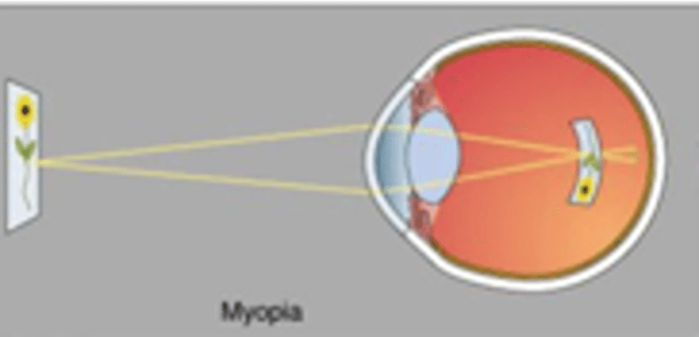 <p>Myopia is also known as near-sightedness, describe this</p>
