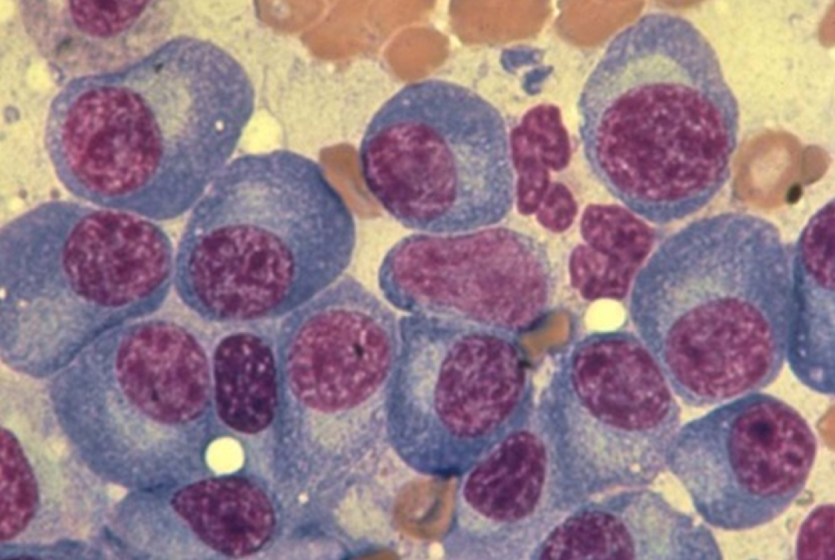 <p>What type of lymphoma is this?</p>