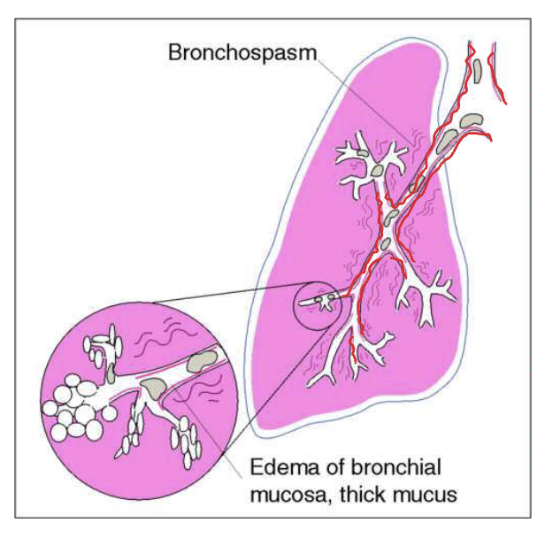<p>widespread, <u>usually intermittent and reversible</u> narrowing of the tracheobronchial tree (bronchospasm and underlying inflammation), diminishing airflow </p><ul><li><p>trachea = midline </p></li><li><p>tactile fremitus = decreased <u>during attacks</u> </p></li><li><p>percussion = resonant to hyper-resonant <u>during attacks</u></p></li><li><p>breath sounds = often obscuring by wheezes <u>during/surrounding attacks</u></p></li><li><p>adventitious sounds = wheezes <u>during attacks </u></p></li></ul><p></p>