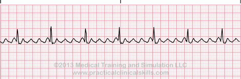 <p>what is this heart rhythm? </p>