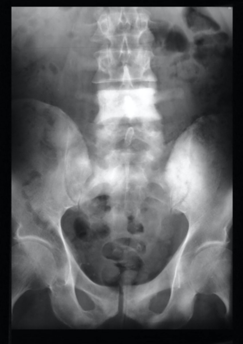 <p>Vignette #1: </p><p>Sex: Male</p><p>Age: 62</p><p>Chief Complaint: Patient presents with low back pain and initiating urinary streams. He reports polyuria in the middle of the night.</p><p>Objective Findings: Kemps + Diagnostic Imaging: X-ray</p><p>Which labs would you expect to be positive? (Choose 3)</p><p>a. PSA</p><p>b. Acid phosphatase</p><p>c. Alkaline phosphatase</p><p>d. ESR</p><p>e. CRP</p><p>f. Proteinuria</p><p>g. BUN</p><p>h. Biopsy for Reed Sternberg</p>