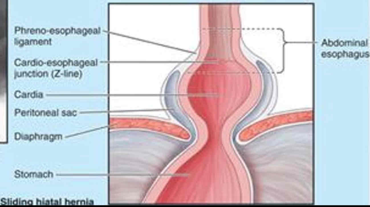 <p>- Abdominal esophagus, cardia, and fundus move superiorly through hiatus when laying down or bending over<br><br>- Regurgitation possible due to weak right crus of diaphragm</p>