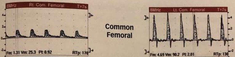 <p>What do the common femoral artery waveforms most likely represent? </p><ul><li><p>Describe L &amp; R waveforms</p><ul><li><p>If diseased, where disease is located and if it is inflow/outflow disease</p></li></ul></li></ul><p></p>