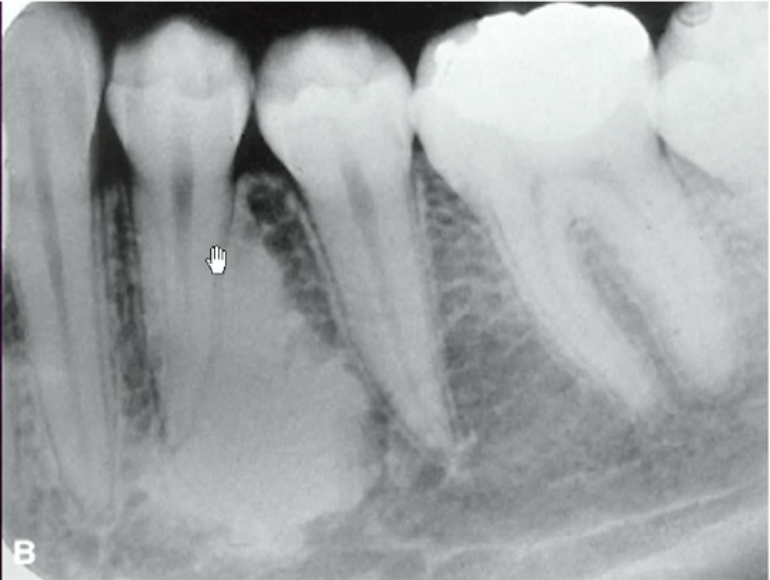 <p>most likely diagnosis </p>