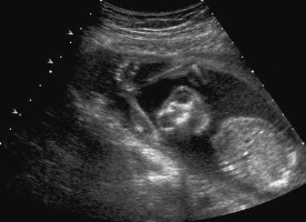 <p><span><span>Which of the following is most likely associated with this finding?<br></span></span></p>