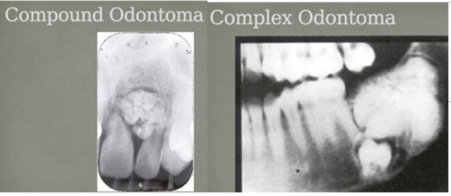 <p>compound: appear as multiple little "toothlets" that often occur in the anterior maxilla</p><p>complex: appear as haphazard deposition of enamel and dentin that often occur in the posterior mandible</p>