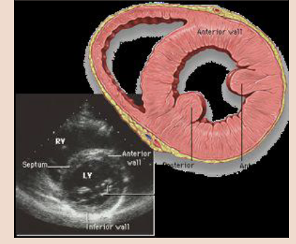 <p><span style="color: #000000">In the PSAX view, the transducer remains in the intercostal space used to obtain the parasternal long axis view and is rotated clockwise 90 degrees so that it is perpendicular to the long axis of the LV (probe marker to left shoulder). It is then tilted to sweep through from base to apex of the heart,</span><span style="color: #000000"><br></span><span style="color: #000000">obtaining a number of different views.</span><span style="color: #000000"><br></span><span style="color: #000000">• PSAX examine the shapes and sizes of the ventricles. The LV should be bigger than the RV. The LV should be round, and the RV crescent shaped like a reverse letter ‘D’.</span></p>
