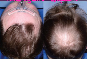 <p>most common type of alopecia, hair transitions from terminal to vellus hair </p><p>-more common in males</p>