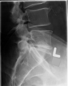 <ul><li><p>MAIN: lumbosacral IV Space open</p></li><li><p>L5 peds SI sup/inf</p></li><li><p>SAP SI inf/sup</p></li><li><p>pelvic alae nearly SI sup/inf</p></li></ul><p></p>