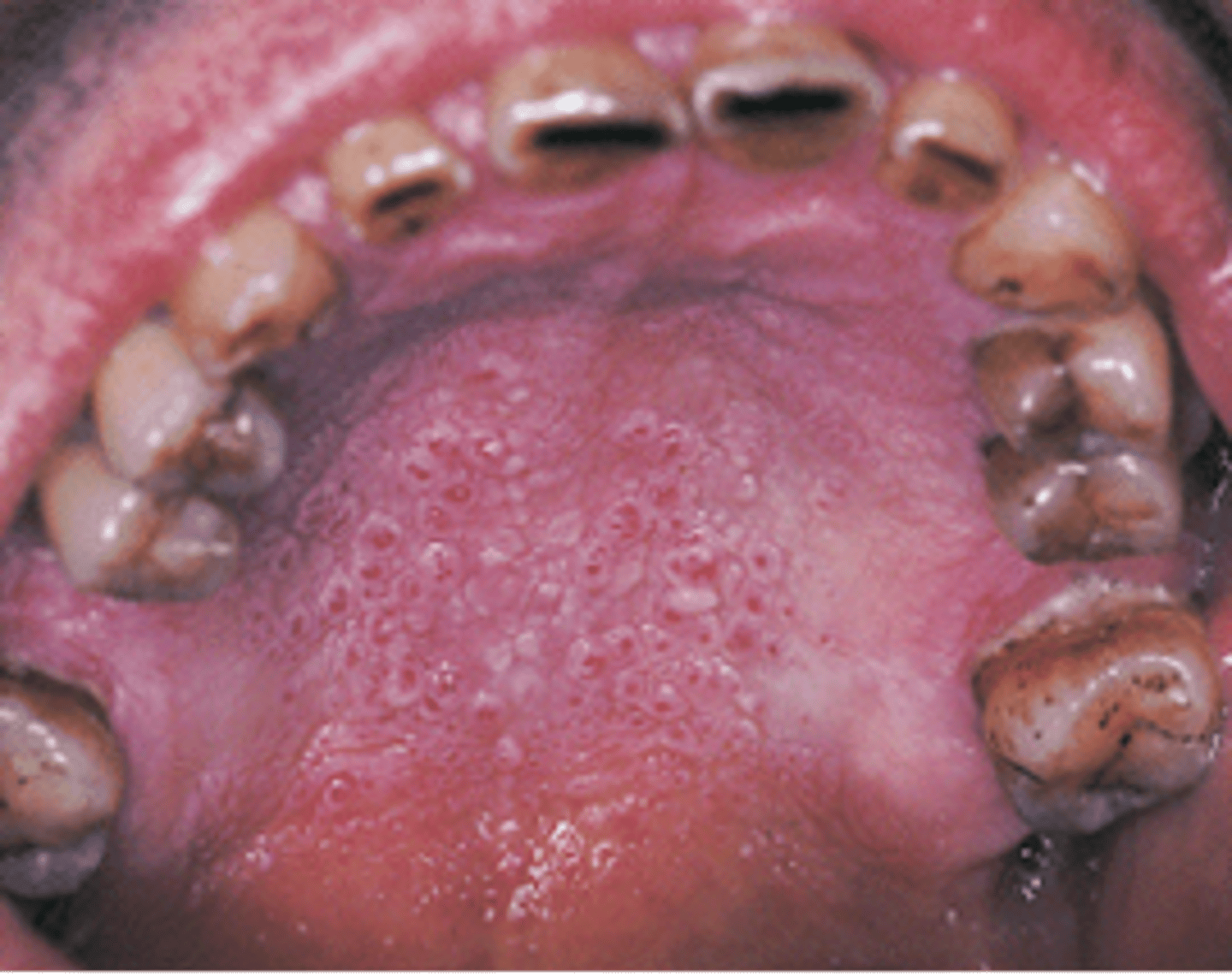 <p>Nicotinic Stomatitis</p>