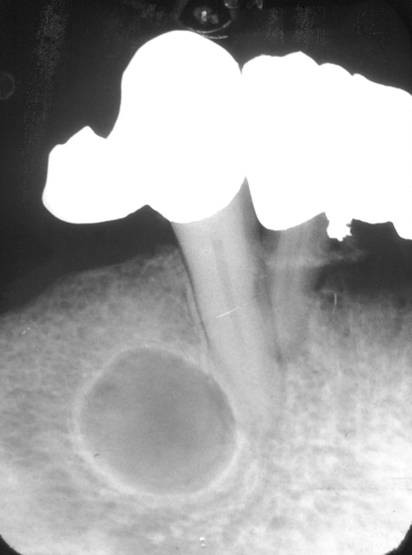 <p>the differential for this incidental finding on an asymptomattic patient should include the following EXCEPT: </p><p>lateral periodontal cyst</p><p>odontogenic keratocyst</p><p>residual cyst</p><p>complex odontoma </p>