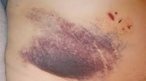 <p>What is a hemorrhagic spot or blotch, larger than petechia, in the skin and mucous membranes, forming a nonelevated, rounded, or irregular blue or purplish patch?</p>