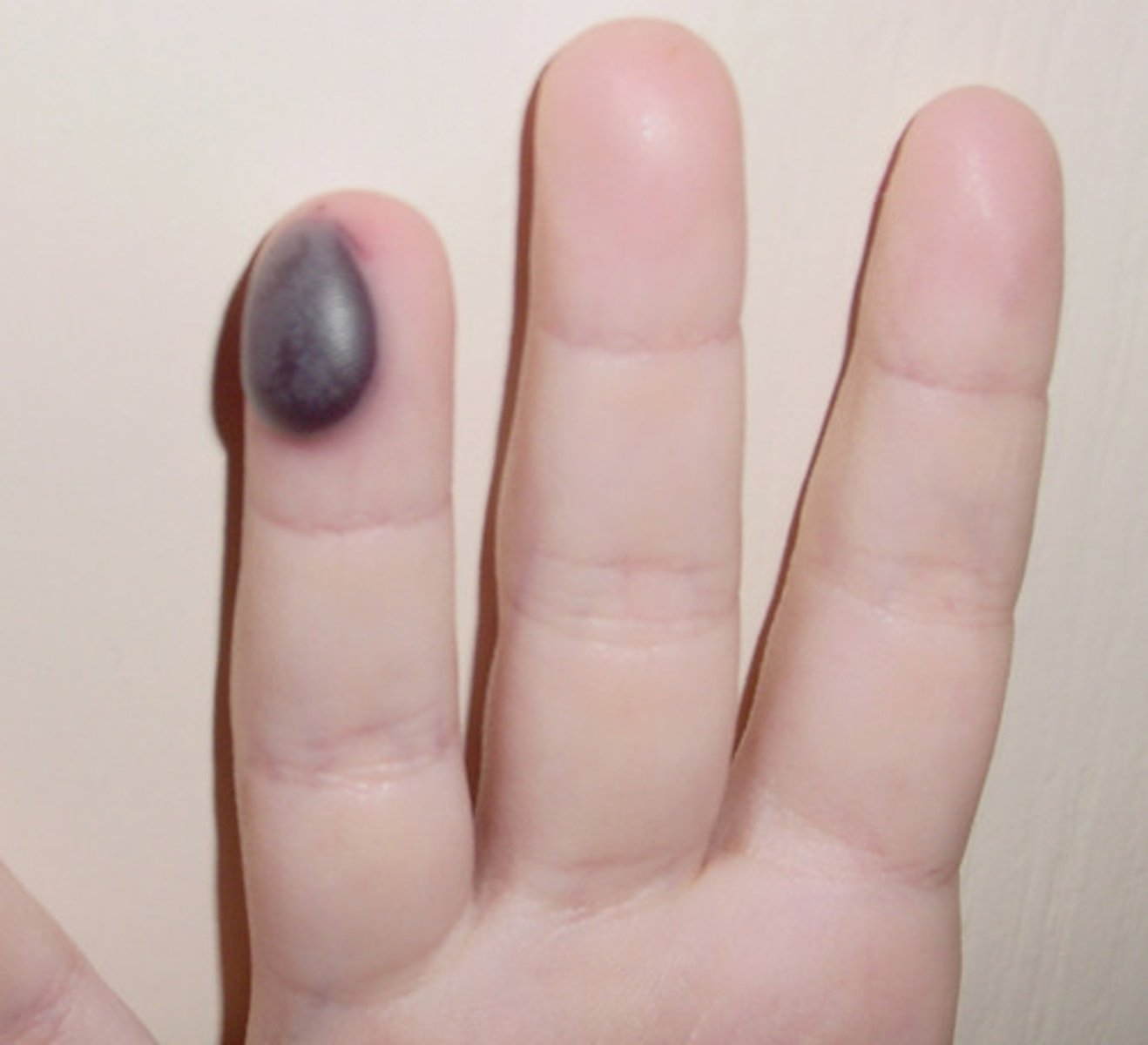 <p>Bruises forms when blood escapes from circulation and clots beneath the skin called hematomas</p>