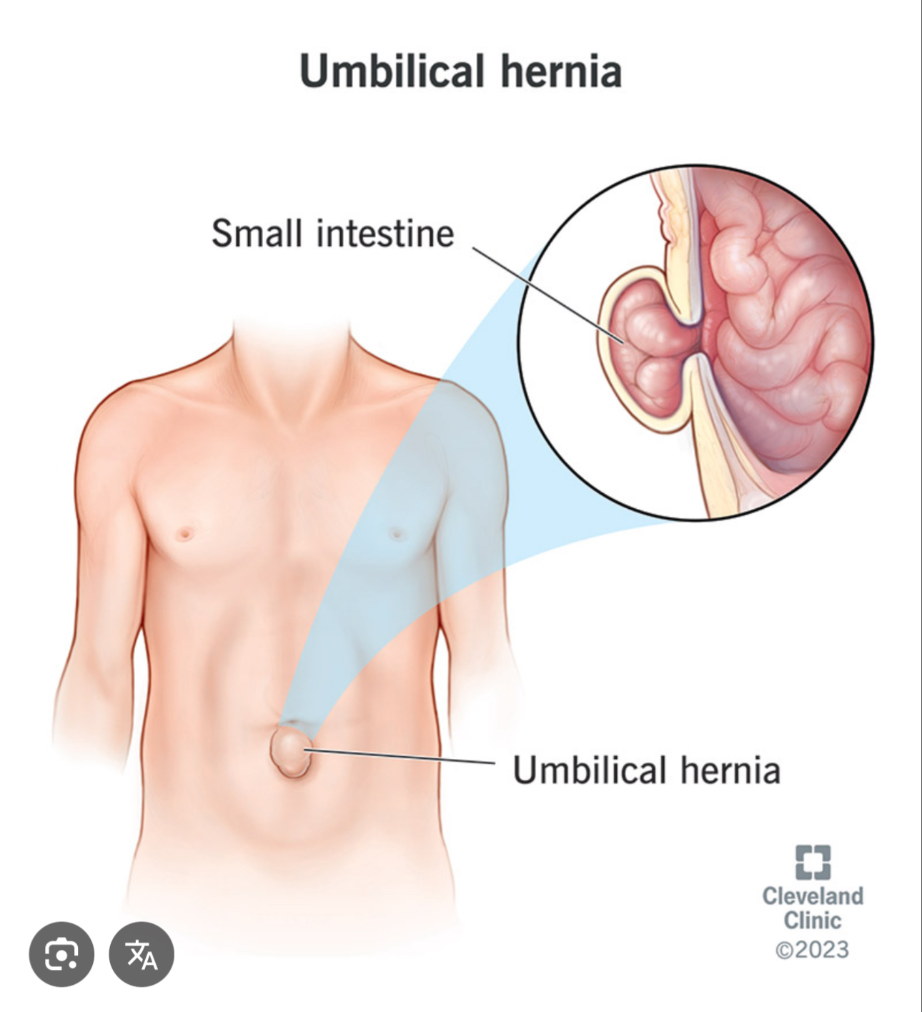 <p>The navel or the belly button a scar left from the umbilical cord in the abdomen</p>