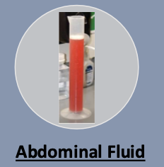 <p>-if sample contains frank blood or is serosanguineous</p><p>-does not clot</p><p>-neoplastic effusion (lower glucose + higher lactate than non-neoplastic)</p><p>-often no evidence of malignant cells in effusion</p>