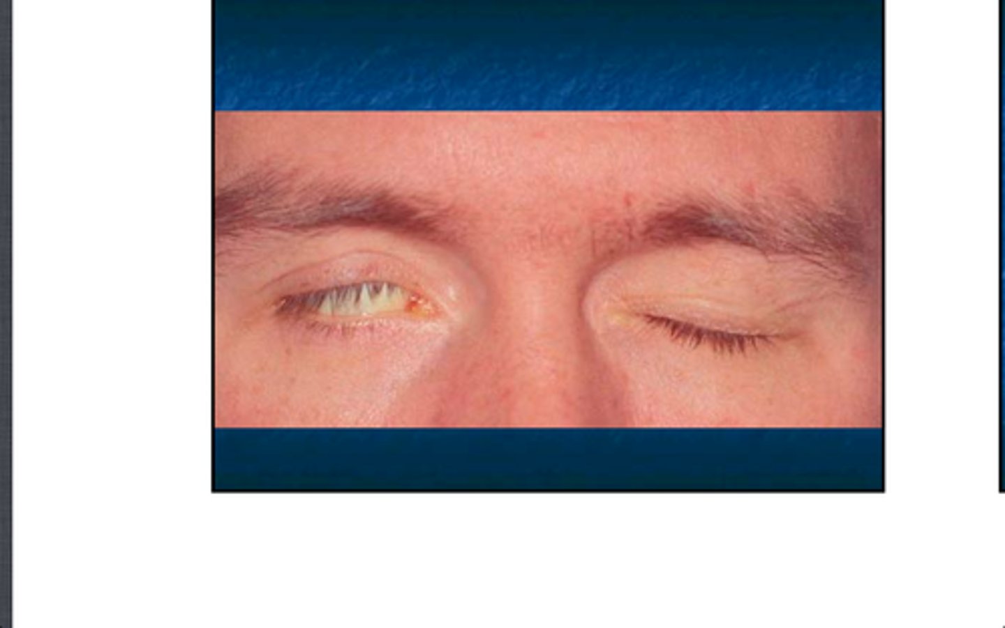 <p>Lagophthalmos; cornea may become dried and be at increased risk for infection</p>