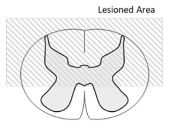 <p>A 30 year old male experienced a spinal cord lesion at the level of L1. The posterior half of the spinal cord has been damaged (image), though the anterior portion remains intact. Which of the following symptoms would u expect to see? </p><ul><li><p>bilateral loss of motor. to anterior trunk </p></li><li><p>loss of proprioception in legs </p></li><li><p>bilateral loss of motor to arms </p></li><li><p>loss of temperature sensation in feet </p></li></ul><p></p>