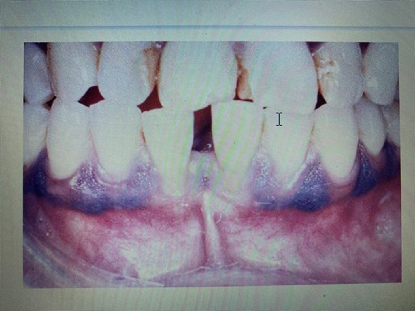 <p>Normal; melanin pigmentation</p>