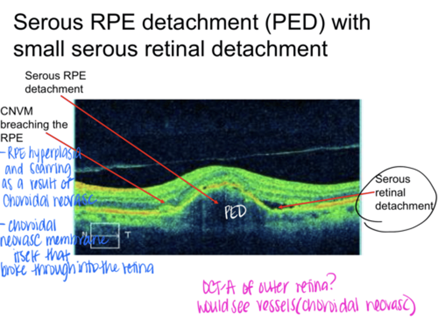 <p>Where is the serous retinal detachment in this pic?</p>