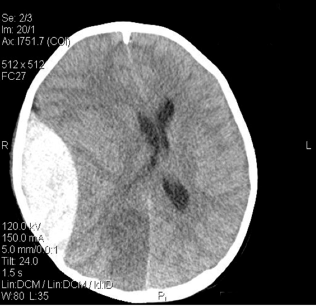 <p>-CT<br><br>-Mass-effect on brain <br>(crescent-shaped)</p>