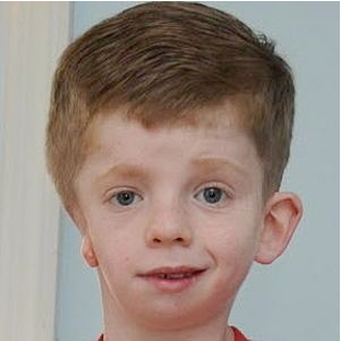 <p>which skeletal defect is shown in this image</p>