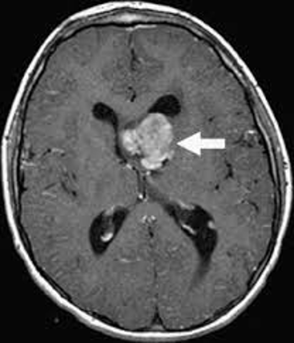 <p>tumor deriving from Astrocytes; basically benign, slowgrowing tumor.</p><p>- surgery, radiation</p><p>- most common</p>