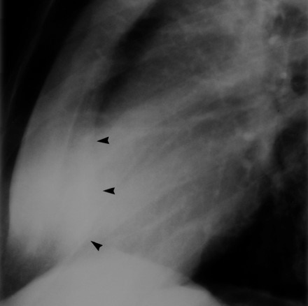 <p>Is there any rotation in this Lat sternum?</p>