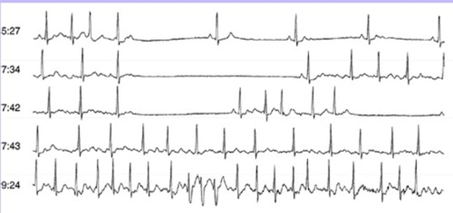 <p>sinus node dysfunction</p><p>- severe depression of sinus node function</p><p>- leads to dizziness/ syncope from excessive bradycardia</p>