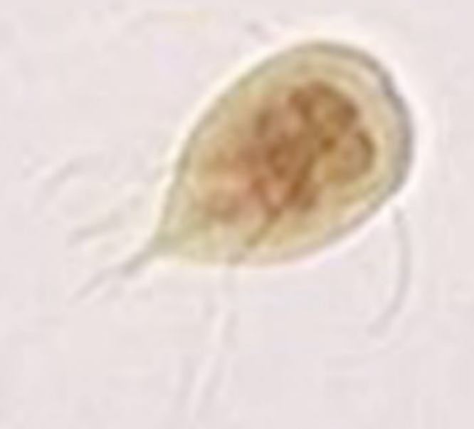 <p>trophozoites attach to surface of SI enterocytes and cause blunting of intestinal villi</p><p>--> maldigestion, malabsorption, diarrhea</p>