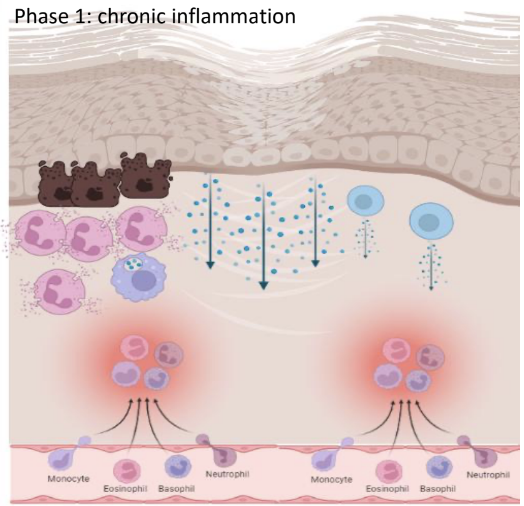 <p><em>Tissue destruction / Scarring:</em></p><p>• <strong>Continuous or enhanced recruitment of granulocytes: </strong></p><p><span style="color: red;"><strong>degranulation leads to epithelial damage,</strong></span> further breaches </p><p>in the barrier.</p><p>• <strong>Accumulation of MP</strong> <strong>with enhanced production of cytokines, </strong><u>causing further activation</u> of other immune and structural cells. </p><p>• MP products <u>can also damage the epithelium.</u></p><p>• Adaptive immune cells are also recruited and activated,<span style="color: green;"><strong> increasing cytokine production.</strong></span></p>