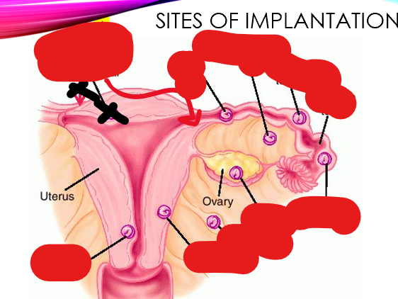 <p>sites of implantation for ectopic pregnancies</p>