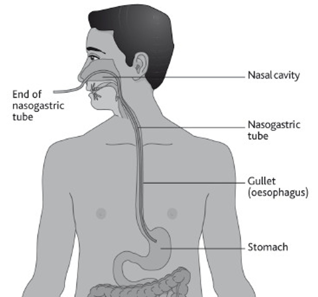 <p>tube inserted through the nose into the stomach</p>